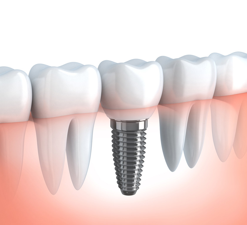 dental103 berlin implantate implantologie